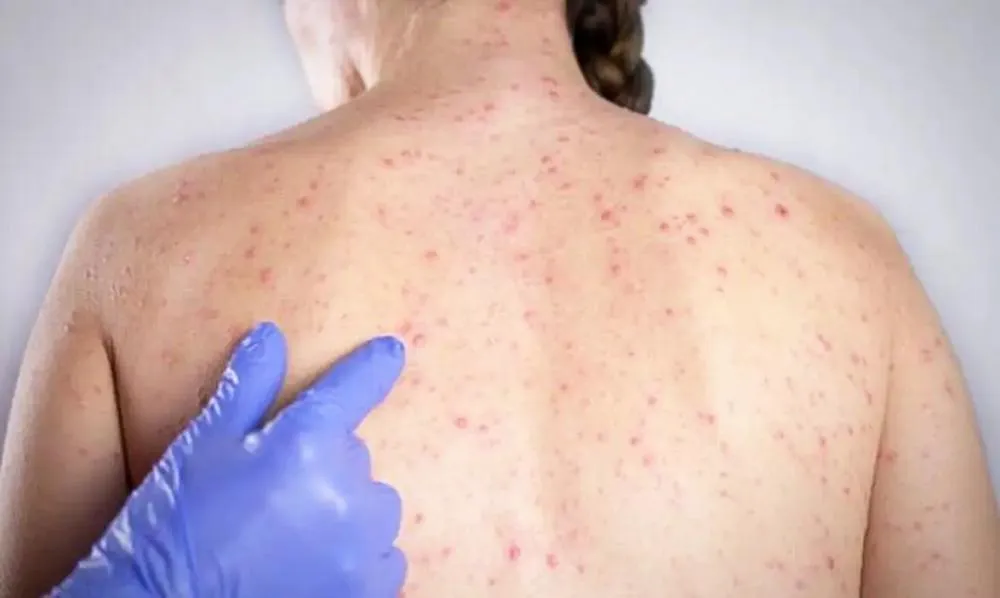 Pacientes foram diagnosticados na capital e em mais duas cidades - Divulgação